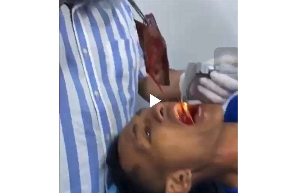#ENVIDEO: Médicos le extraen de la garganta un pescado a un joven en Pivijay