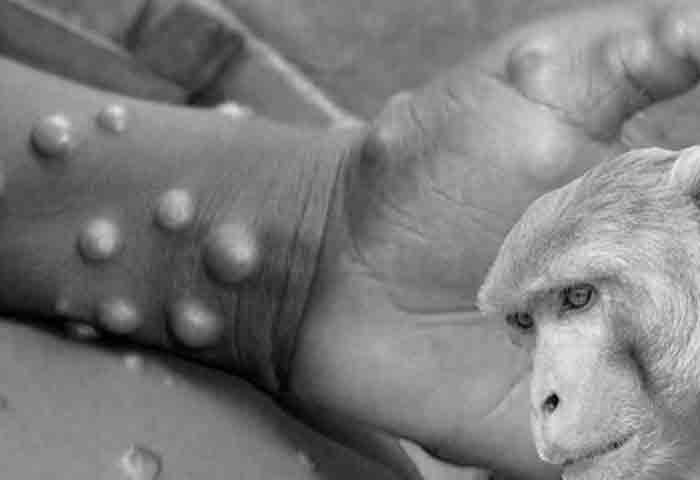 OMS cree que la viruela del mono circuló algún tiempo sin ser detectada